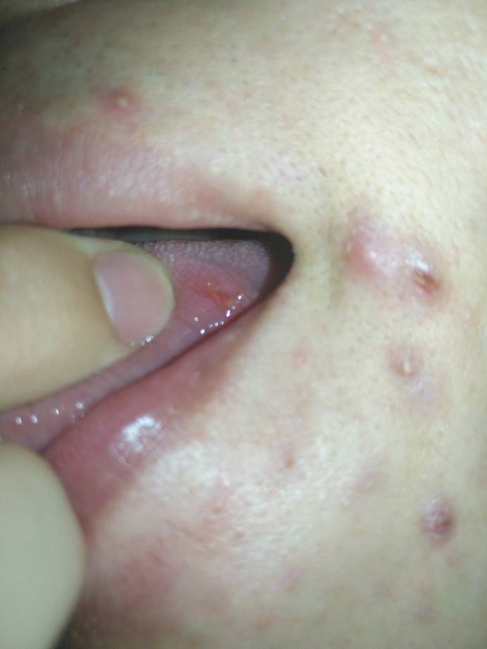 舌头起了个泡然后越来越痛了咋办