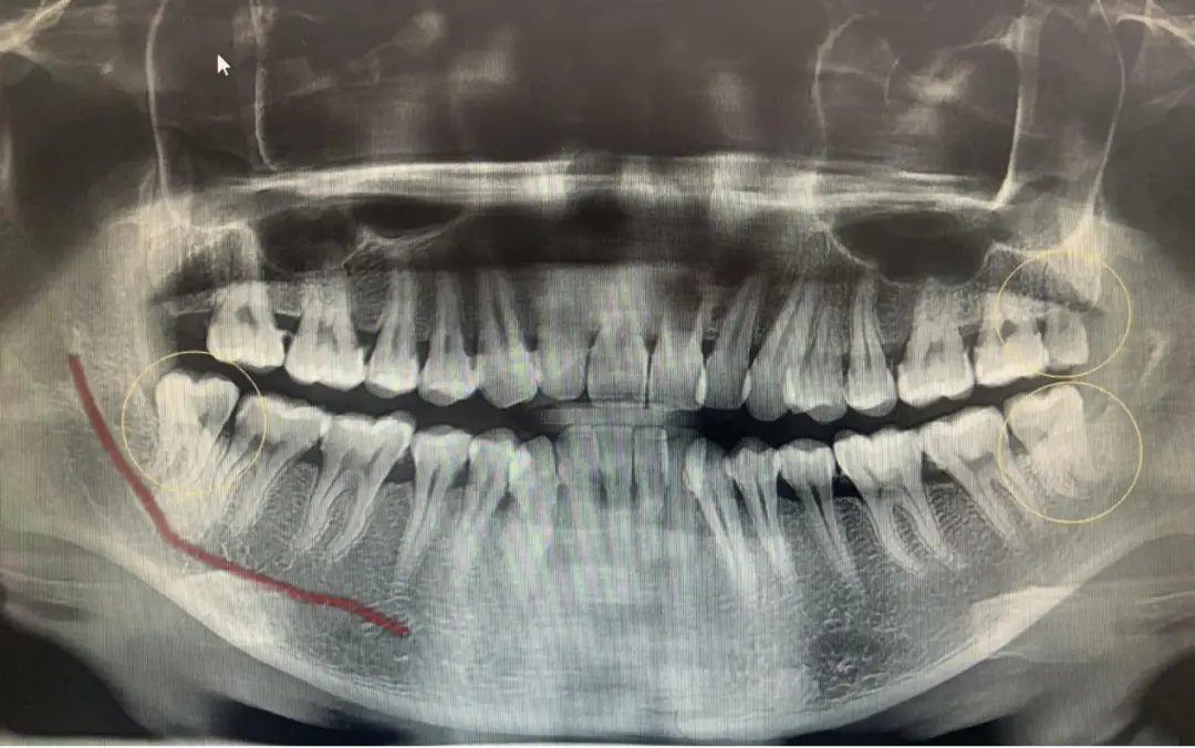 看牙拍片子真的很必要