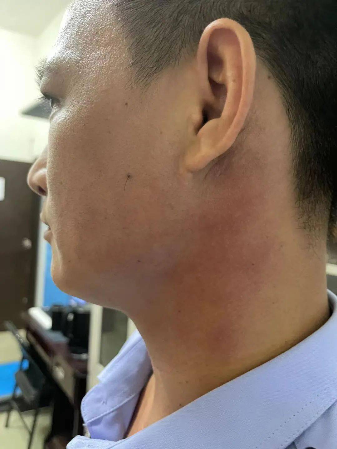 派出所民警的调查工作后,刘俊带着深红色的巴掌印去医院做了伤情鉴定