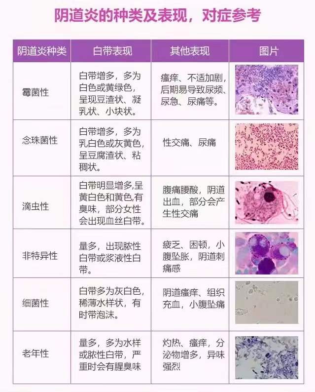 阴道炎种类及表现,对症参考_盐城_症状_概念