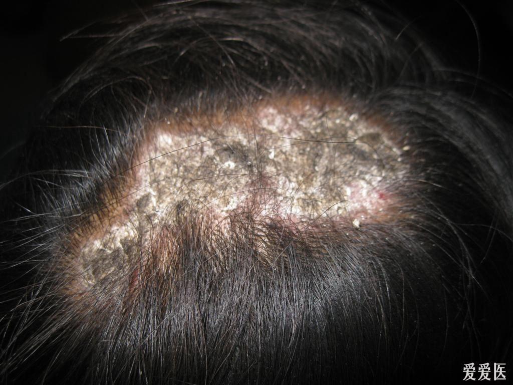 头癣