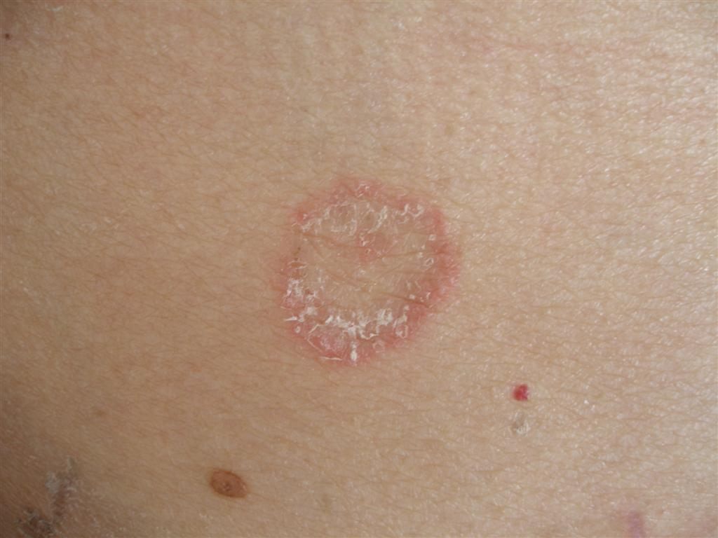 花斑癣会不会传染预防治愈双管齐下