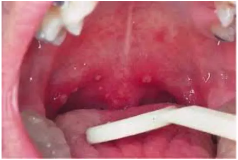 可出现在两颊部,硬腭,咽后壁,舌头,唇齿侧,偶尔还会出现在软腭,悬雍垂