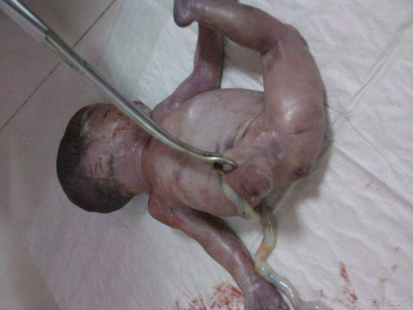 畸形胎儿一例