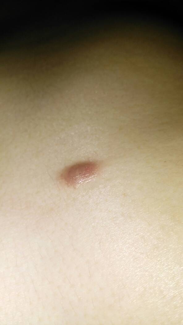 开始身上起了一个粉刺,我给挤掉了,之后就成一个硬疙瘩,都快一年了