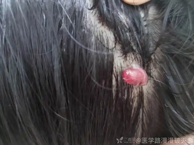 是头皮血管瘤吗