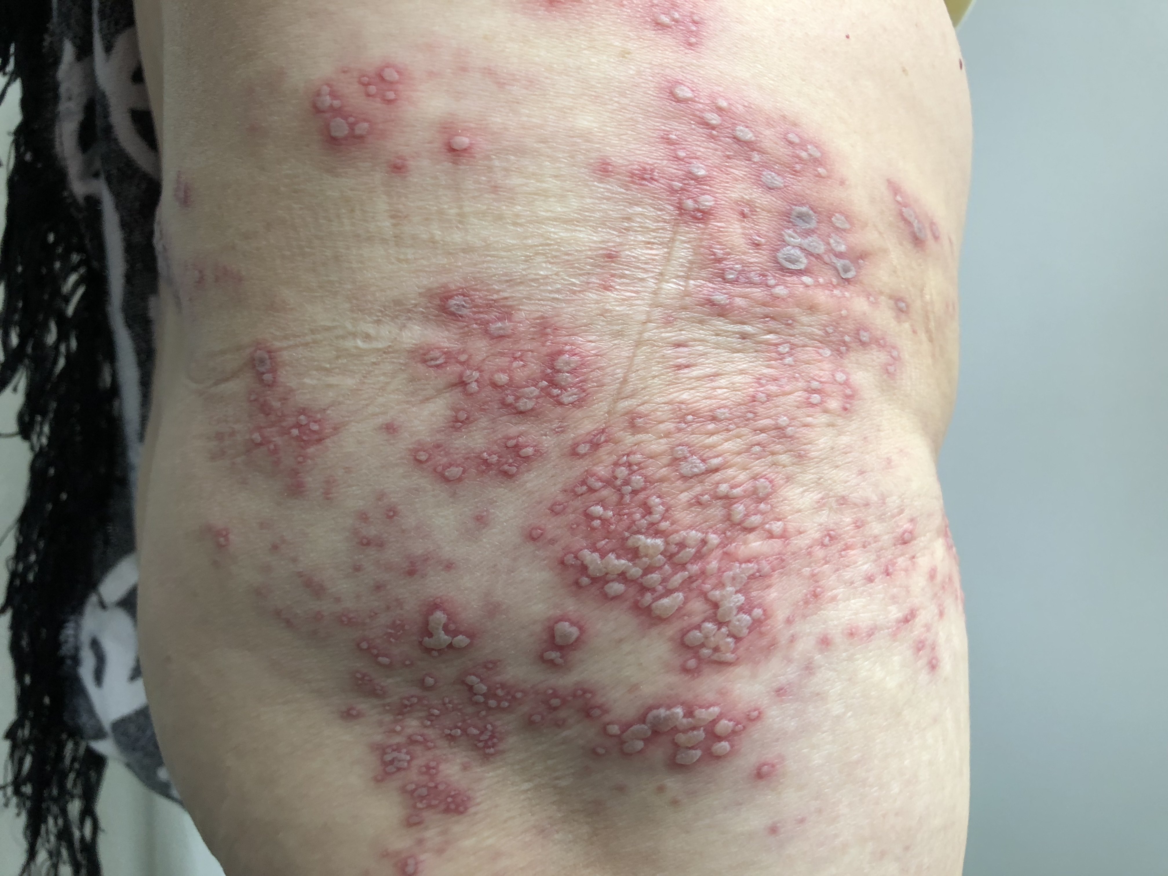 一分钟教您认识带状疱疹("生蛇","蛇串疮")_带状疱疹_症状表现_治疗