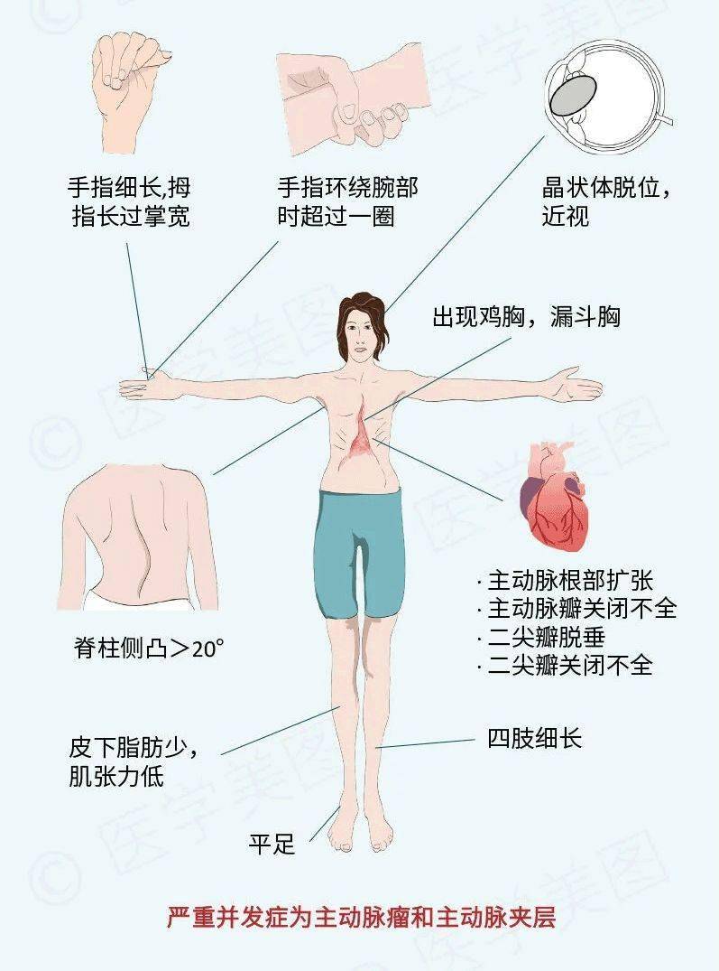 马凡综合征的故事 | 美图赏析