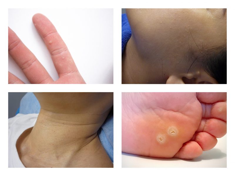 医专荟皮肤疣资讯中心