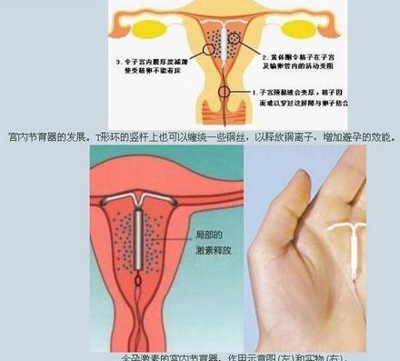 上环是什么意思上环的基本知识及注意事项