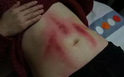 女人经常刮痧原来有这么多的好处