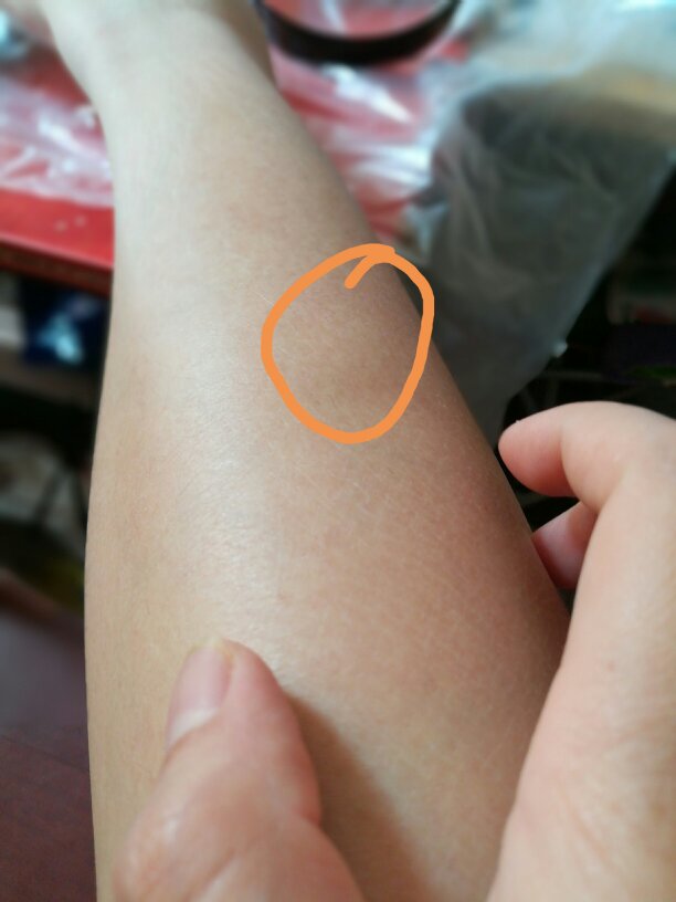 小腿背上长了一个包.