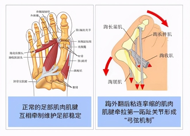 狭小的尖头鞋区域限制了拇展肌的作用,导致拇收肌及拇短屈肌外侧头