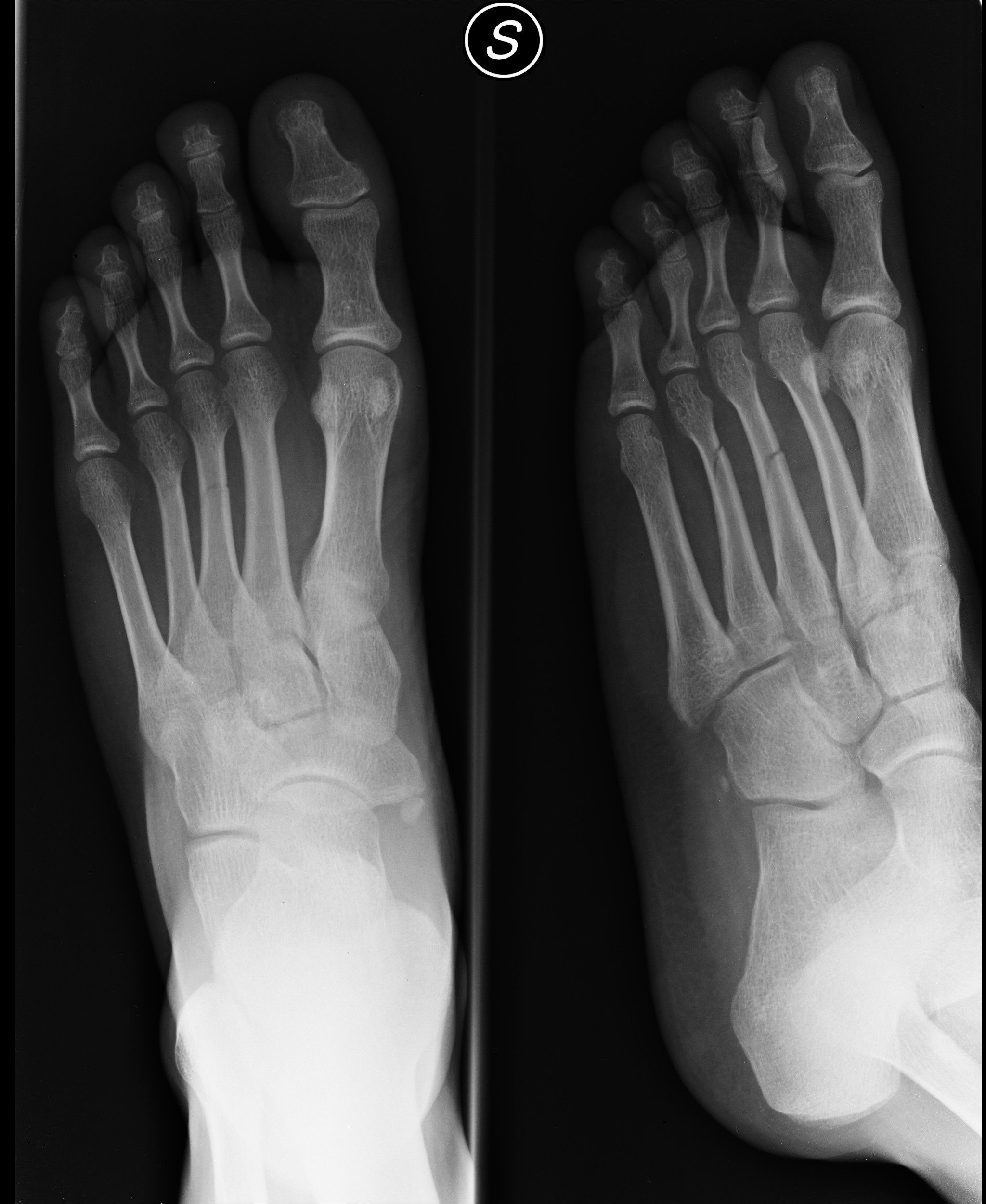 脚掌骨骨折 包了石膏一个月 然后又过了40天. 还是不能正常走路.