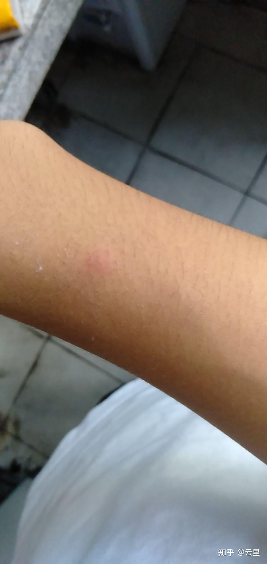 水痘一般都长什么样