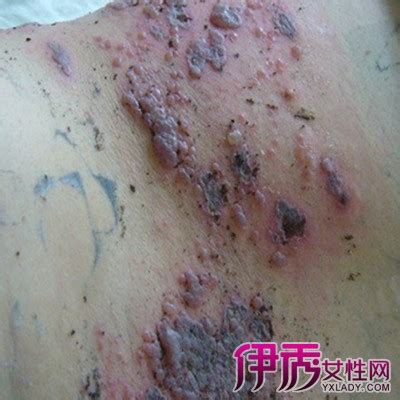 女性得生殖疱疹的症状