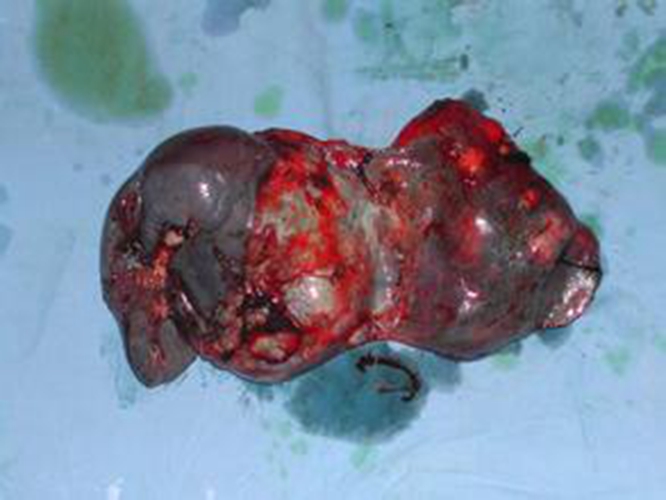 肺腺癌晚期肿瘤图片