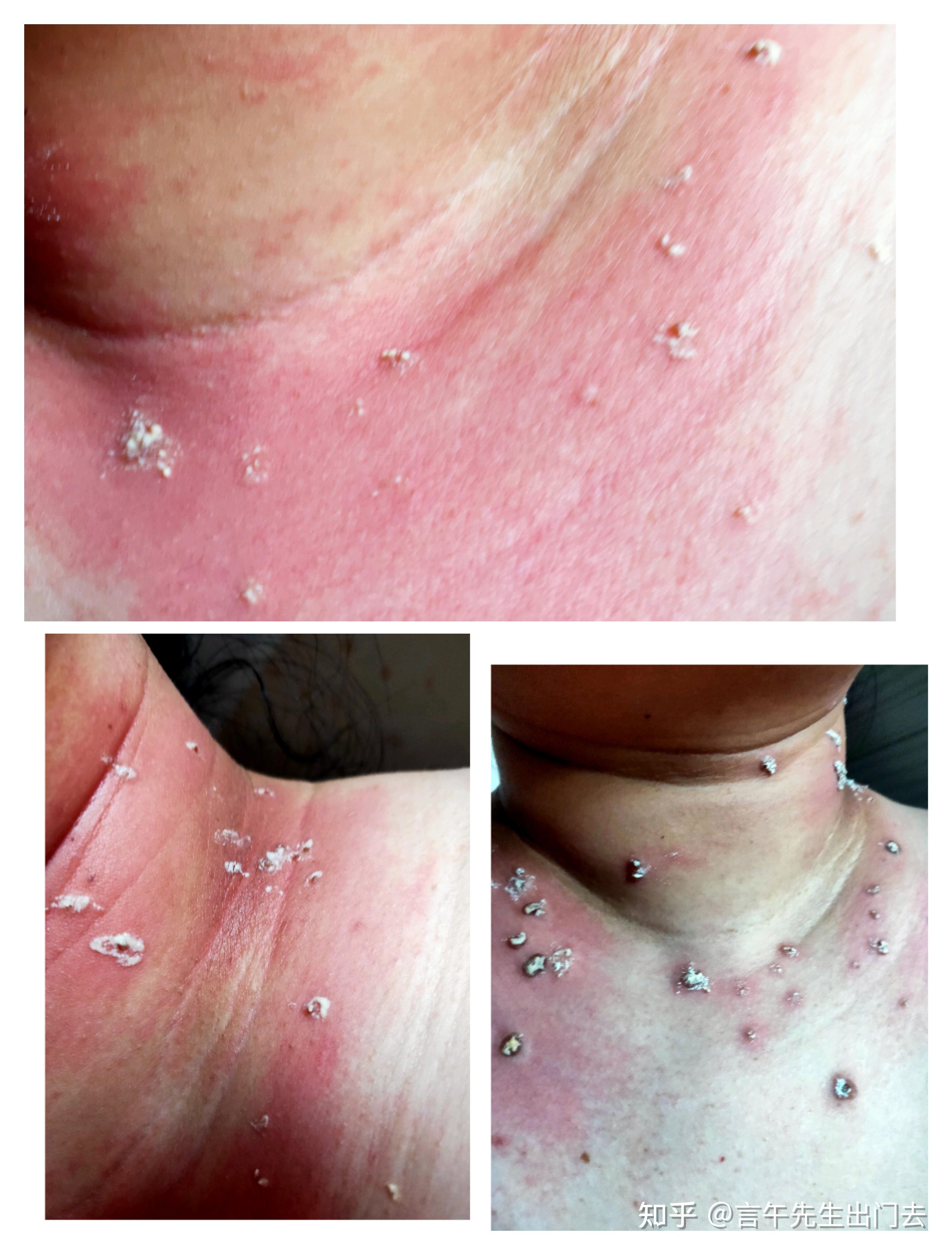 哇喔 太惊喜了 扁平疣疣体 偏方治疗过程记录