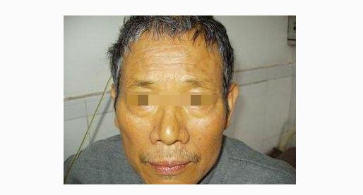 黄疸最常见于肝胆疾病,一般在肝癌的晚期出现,肝细胞性黄疸特征是皮肤