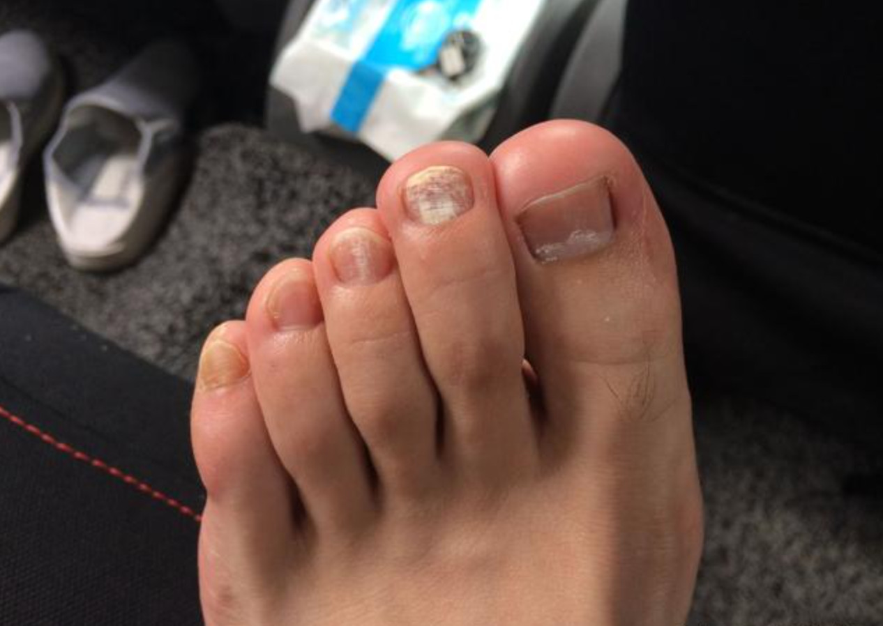 风靡全欧洲的灰指甲笔,7天就有效,20年顽固灰指甲也能救!