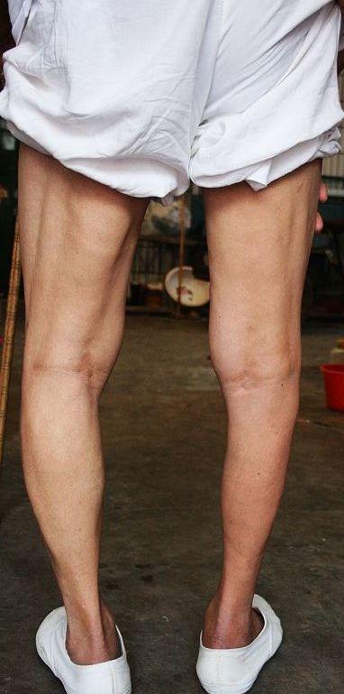 小腿肌肉萎缩