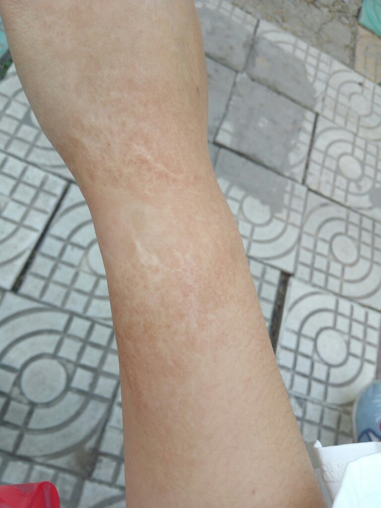 十多年了,请问要怎么把疤痕遮住?