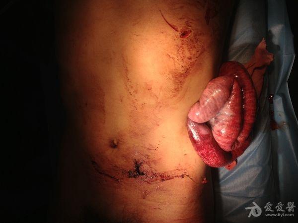 腹部刀刺伤至小肠外露图片