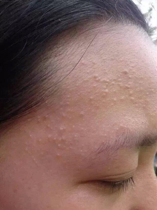 脸上有闭口千万不要用这个