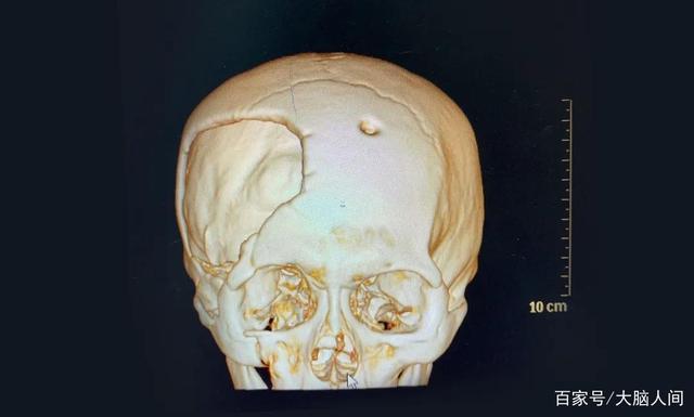 蓝十字脑科 90后小伙头颅受损大面积凹陷 颅骨修补术后他重现笑颜