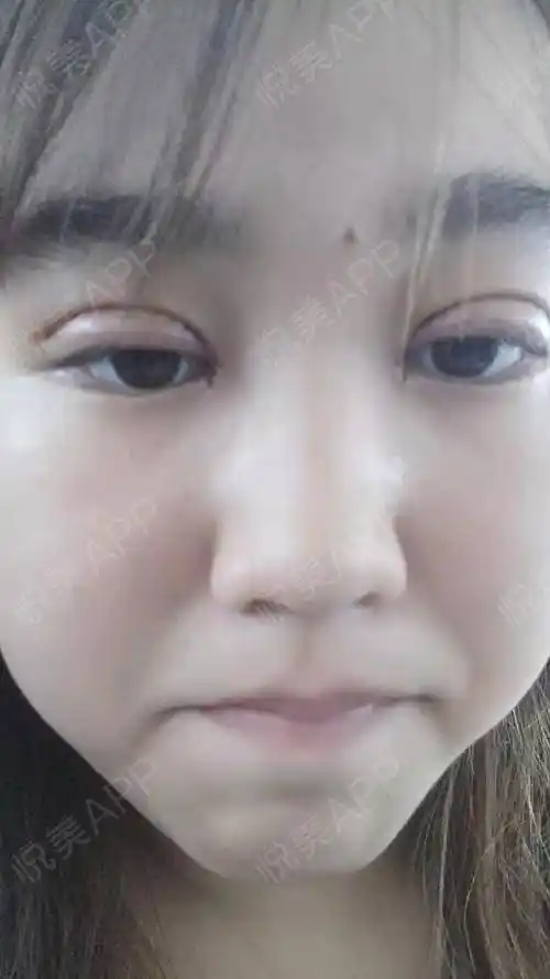 看我的术前照片就知道,虽然我并不是单眼皮,但内双非常严重,基本上