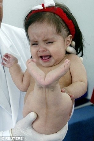 印度首例美人鱼婴儿出生仅存活10分钟(图)