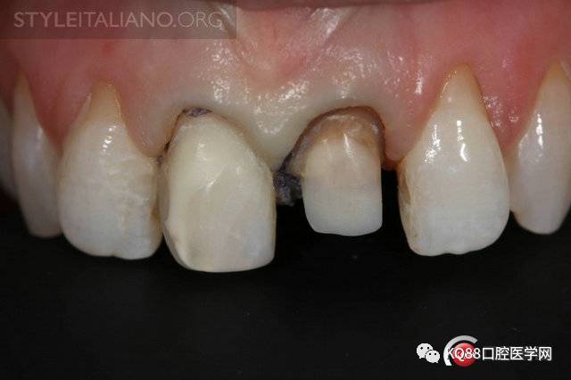 前牙金属桩核处理案例