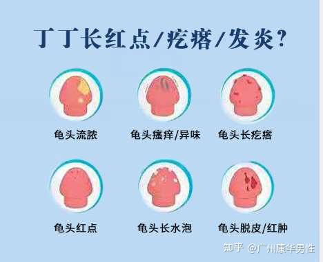 龟头上长有红点是怎么回事番禺男科科普