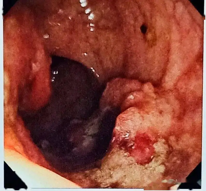 88%的直肠癌曾被当成"痔疮"——这种悲剧仍在天天上演