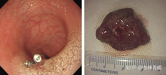 图1 患儿直肠巨大幼年性息肉内镜下电切术图2 患儿术后麻醉复苏中.