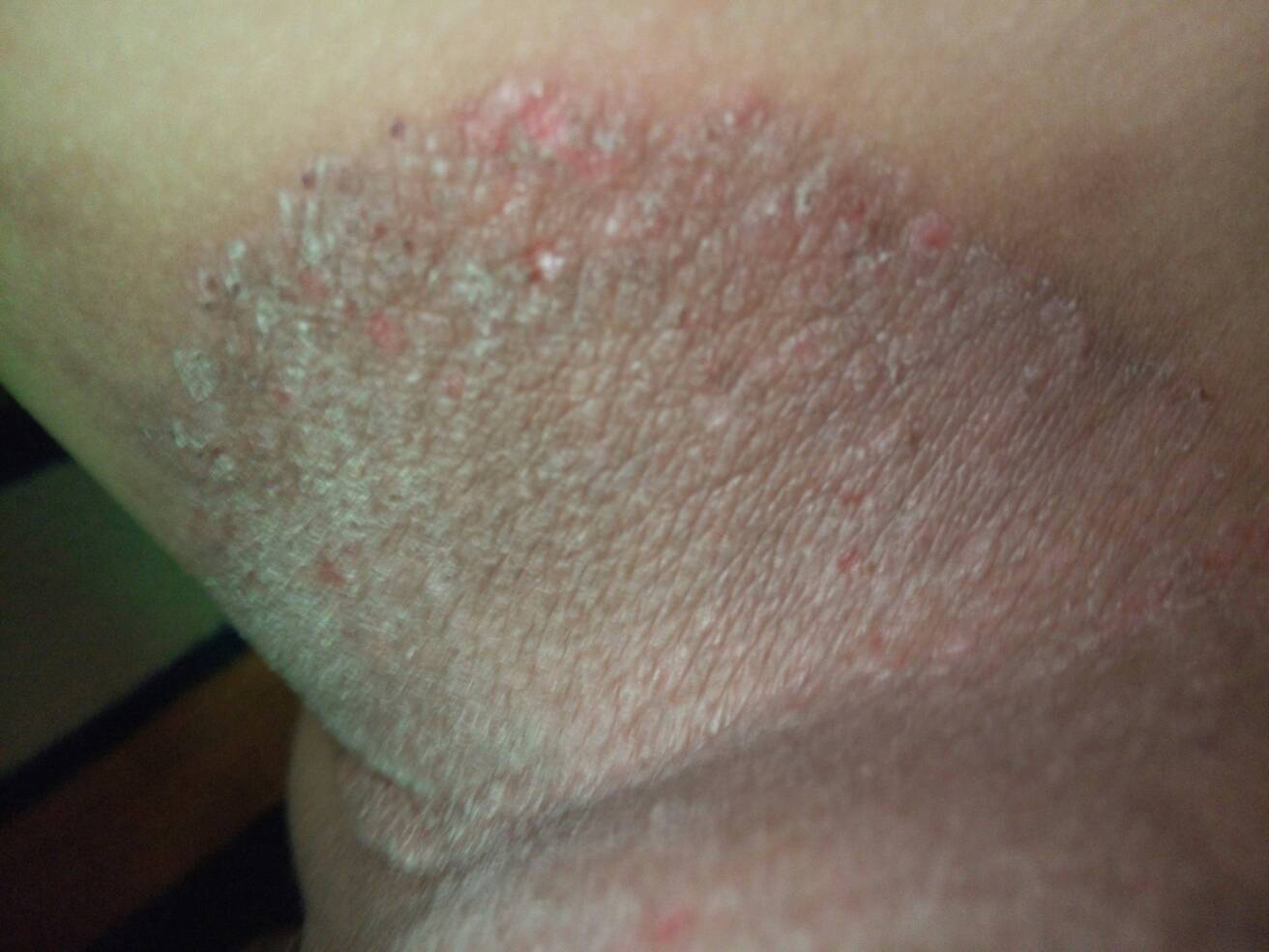 你好,我大腿两侧从去年这个时候就开始痒了,一开始是呈现一个小圆圈