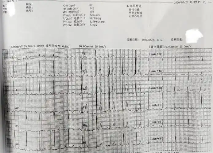 患者外院窦律心电图提示a型预激(左侧显性旁道:即左侧先天存在多的一