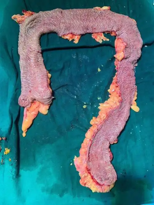 数百枚肠息肉 被移出体外