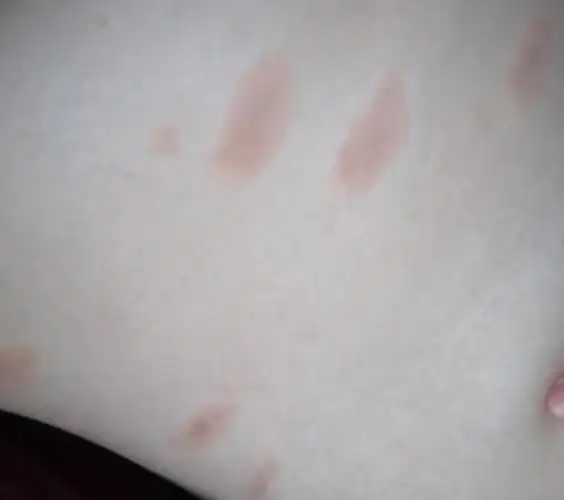 玫瑰糠疹孕妇怎么办?