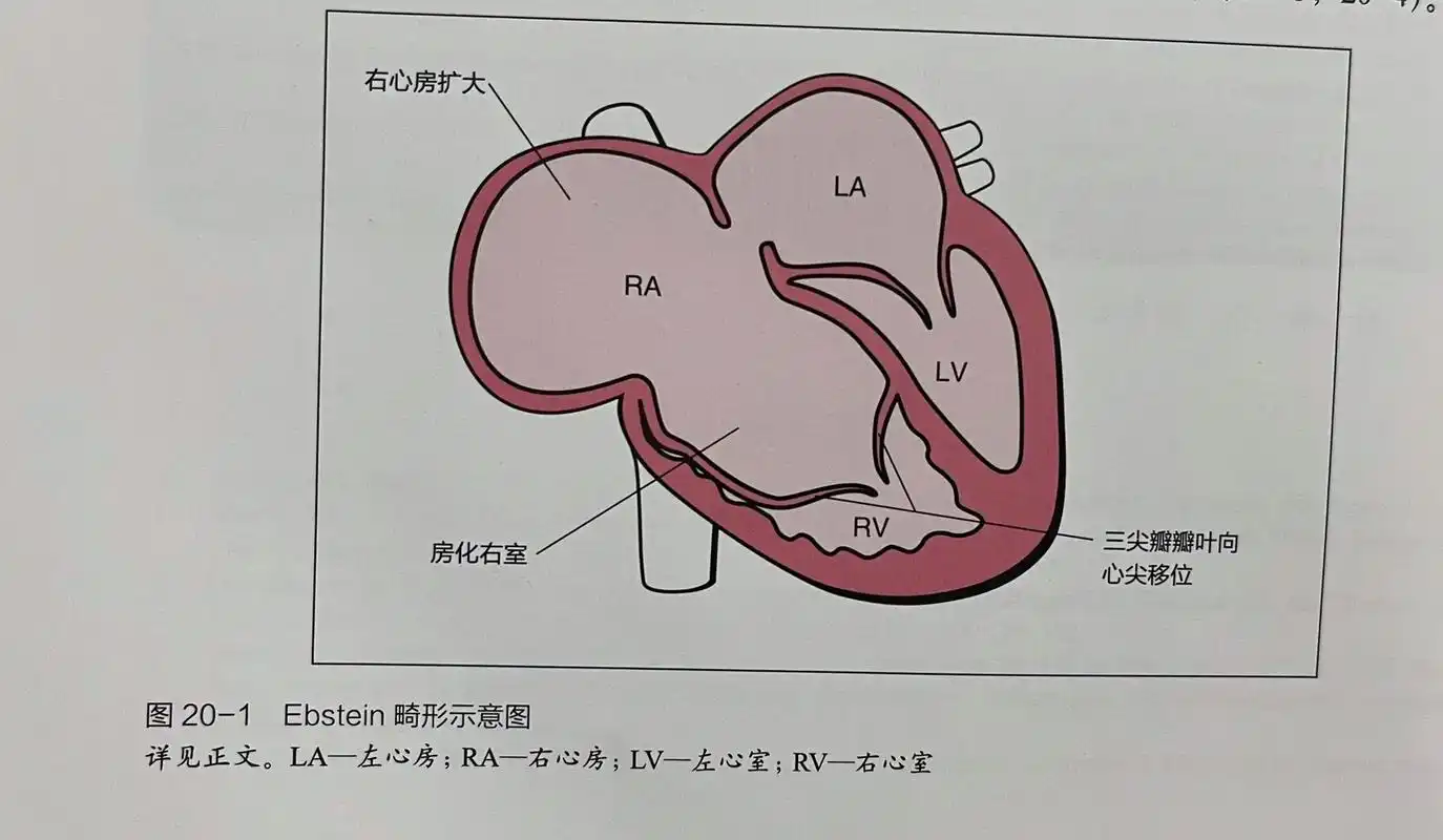 ebstein(三尖瓣下移)你们要的书,它又来啦!很适合大家 - 抖音
