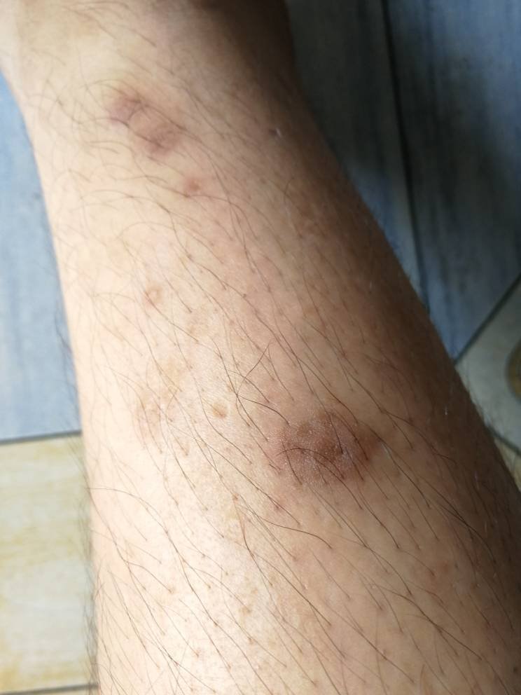 我的腿有这些伤疤已经4-5个月了.