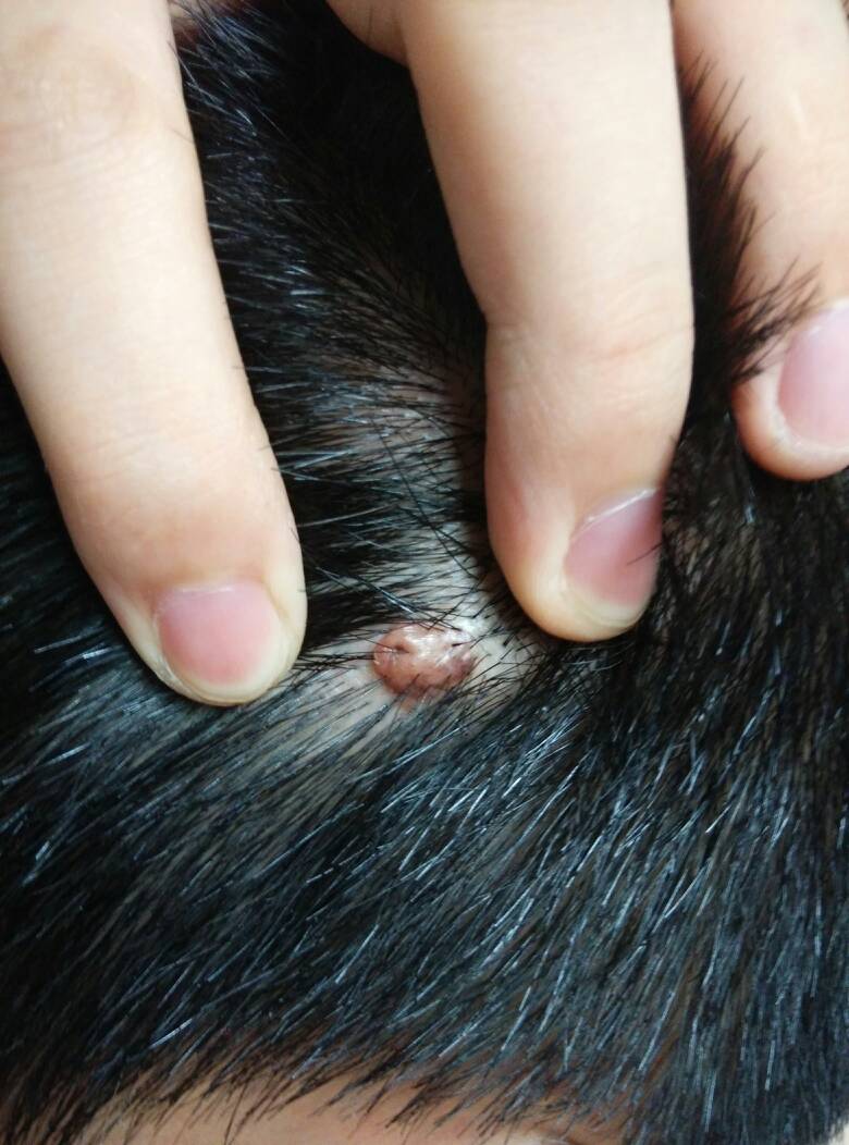 后脑勺有一个半个花生米大的棕色的小肉球,很小的时候就有了,不痛不痒