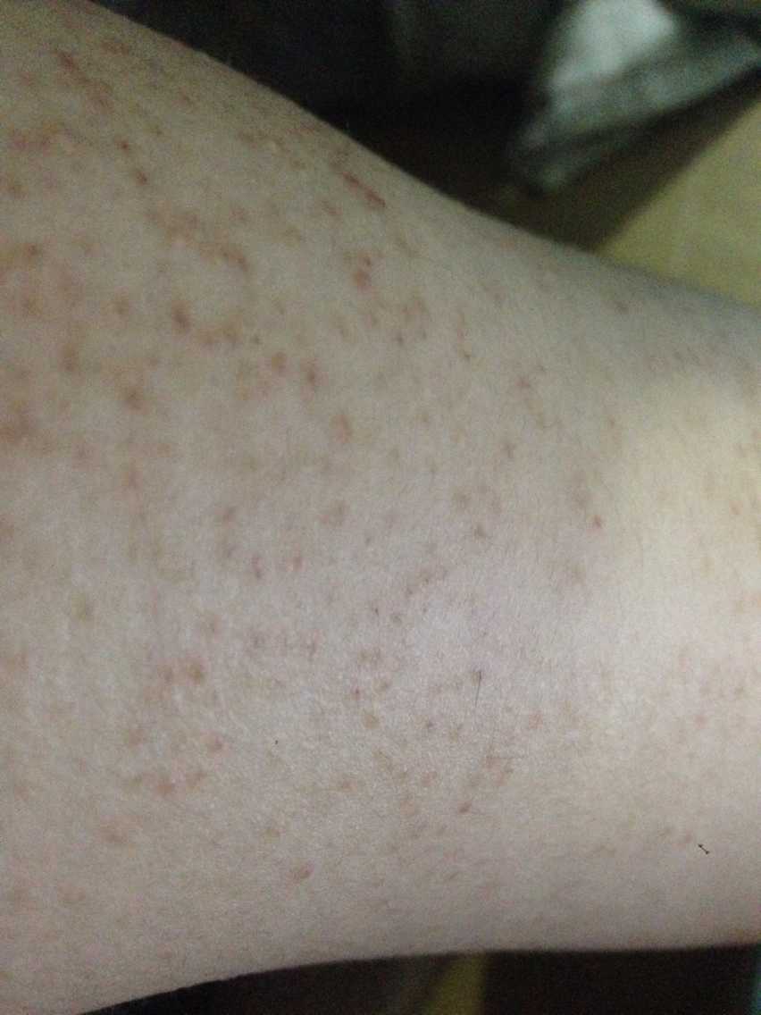 手臂皮肤不知道怎么出现黑点,不痛不痒的,请各位大神帮忙看一下,这个