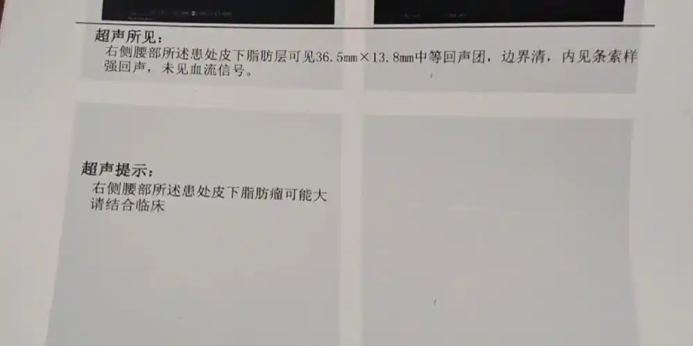 脂肪瘤手术  #感恩日记   在三年前哺乳期发现的腰部有一块肿物,不痛