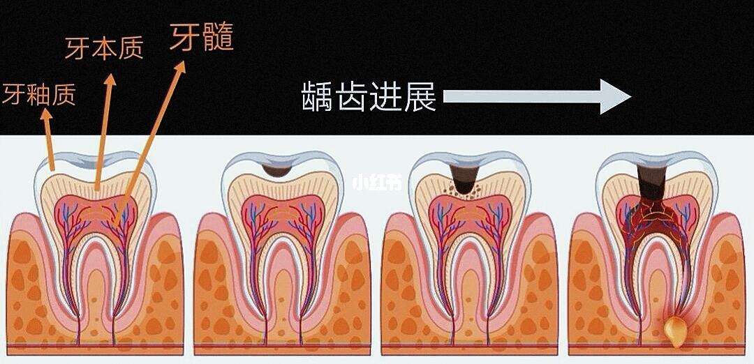 龋齿的进展