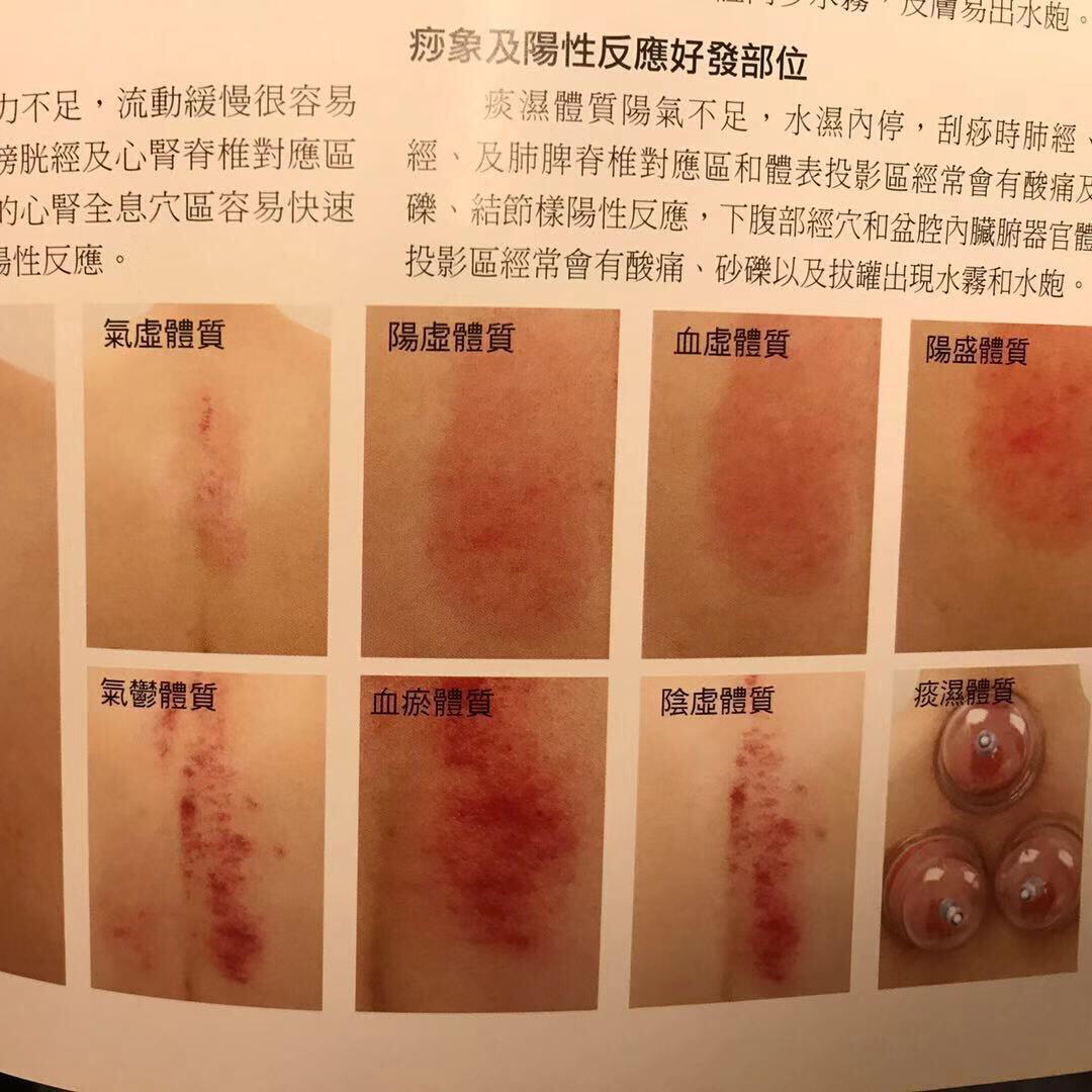 养生 刮痧 排毒 观察自己出的痧来查看自己的体质 求医不如求己!