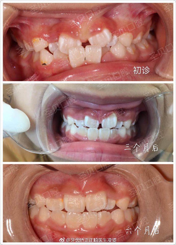 发现孩子牙齿不齐,需及时矫正!为了孩子颜值,宝妈宝爸必看.