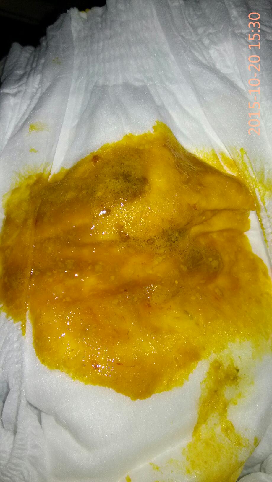 两个多月的宝宝拉屎带血(带图)