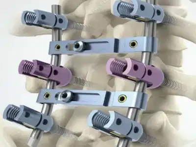 行颈椎管扩大成形术并后路脊柱融合椎弓根螺钉内固定患者作为研究对象