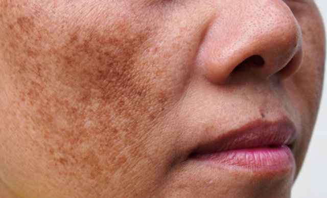 黄褐斑多见于中青年女性,影响面部美观性,可通过激光的方式治疗